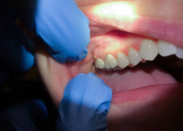 Best Emergency Wisdom Teeth Removal in Farmersburg, IN