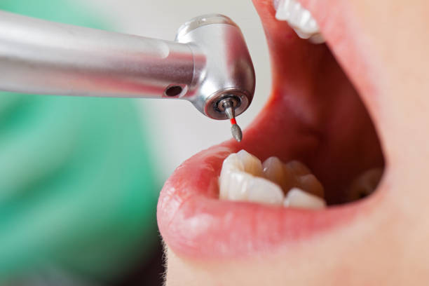 Best Emergency Tooth Extraction in Farmersburg, IN